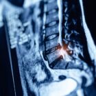 Close up lumbar spine mri scan with highlighted pinched nerve.