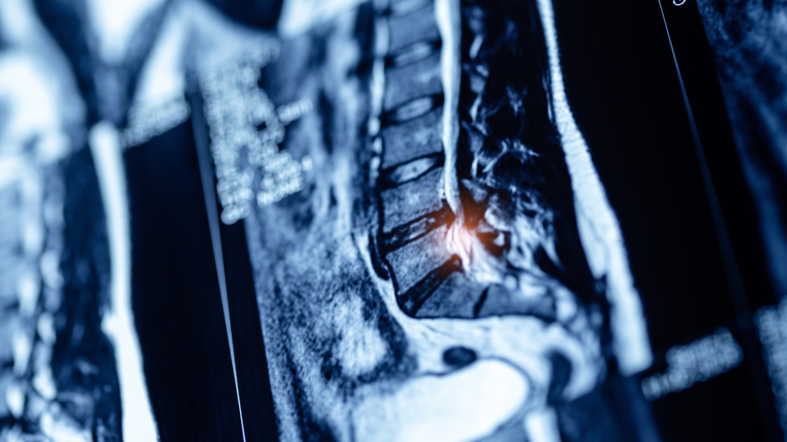 Surgery for a Pinched Nerve in Your Back: What to Know