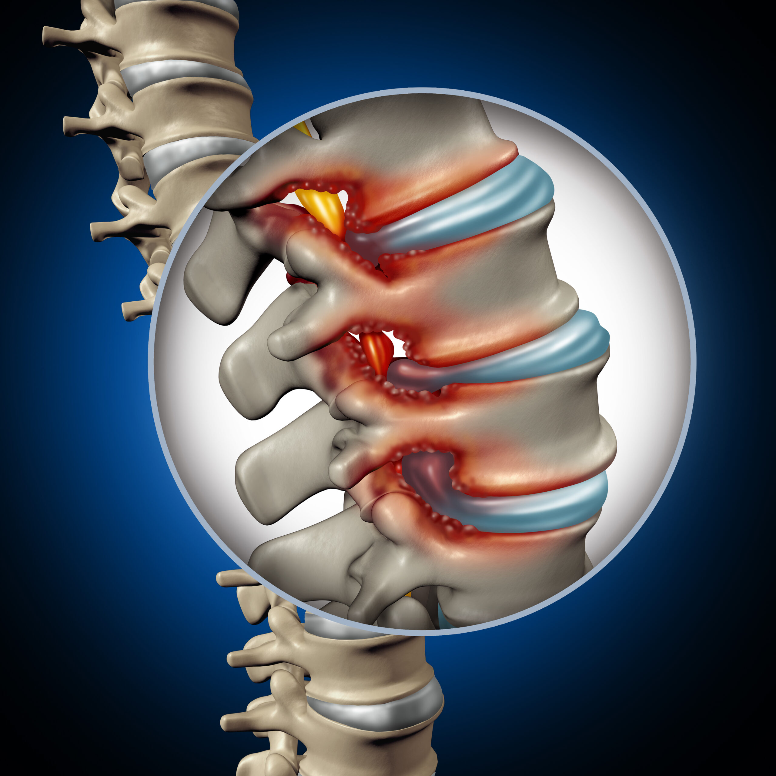 Spinal Stenosis: Causes, Symptoms and Treatment