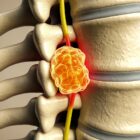 Tumor on a spinal cord.