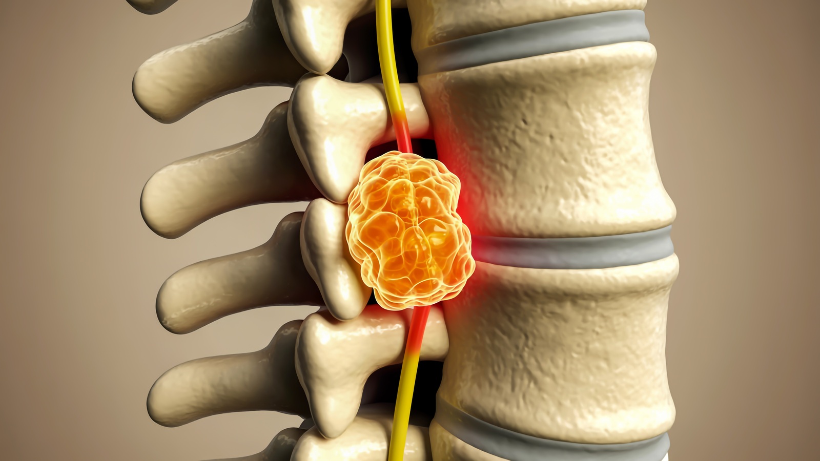Tumor On The Spinal Cord: Signs And Care