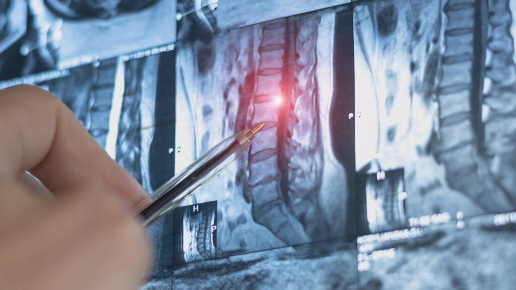 Doctor looking at MRI scan of a spine.