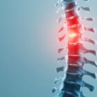 A spine showing spinal stenosis