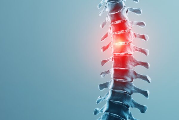 A spine showing spinal stenosis