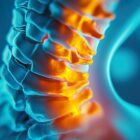 Detailed image of a spine, showing Cervical Stenosis.